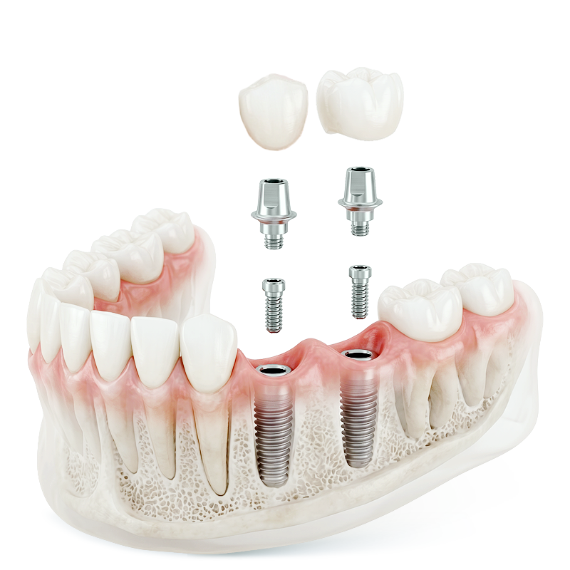 Zahnersatz mit Implantaten